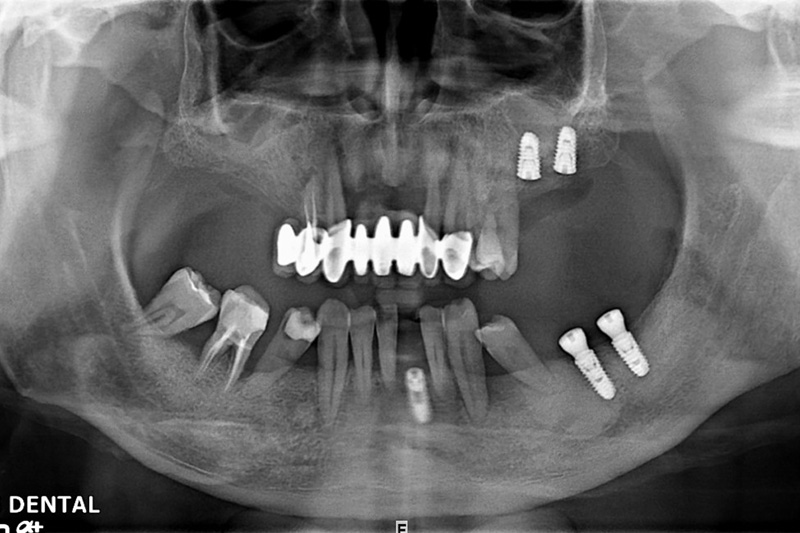植牙案例-宋子濃-1