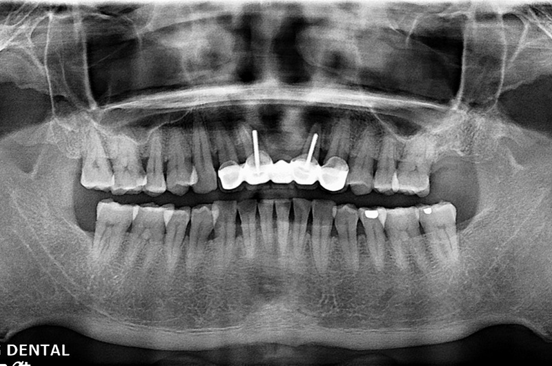 implant-chen-0322-1