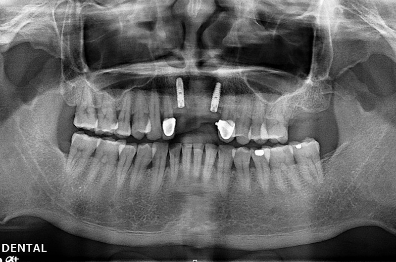 implant-chen-0322-2