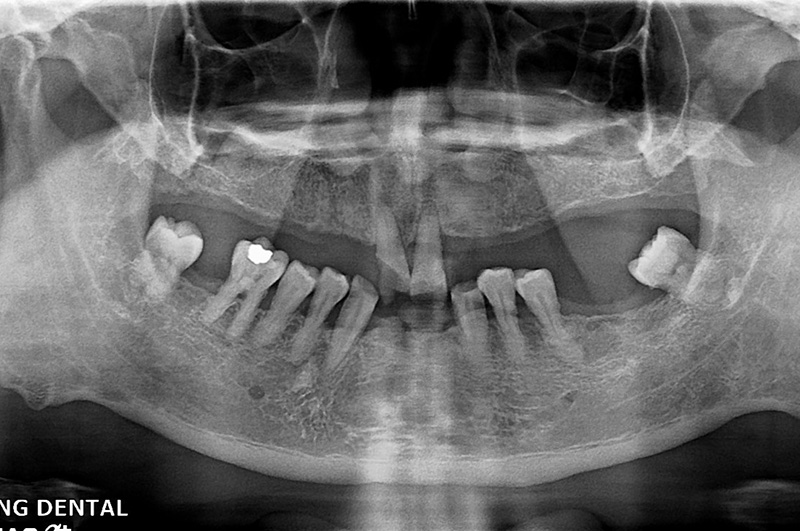 implant-chen2-0322-1
