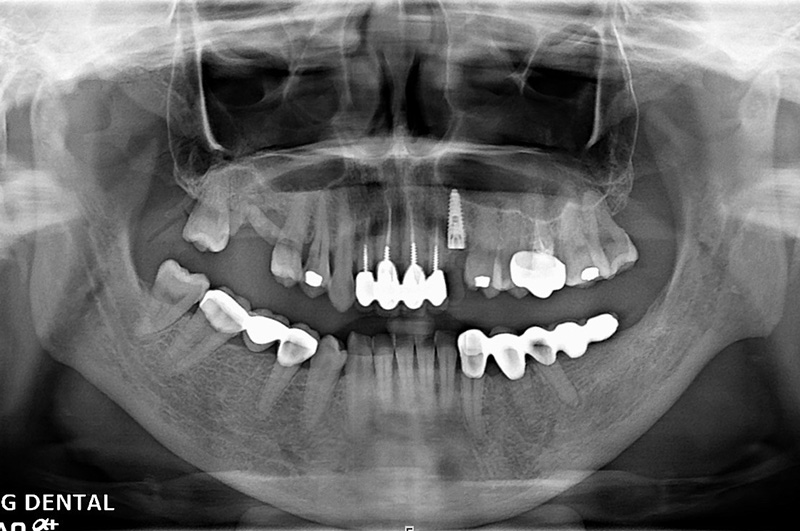 implant-liu-0322-2