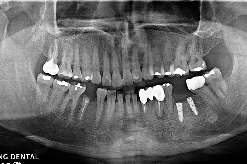 implant-wu-0322-1