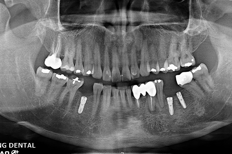 implant-wu-0322-2