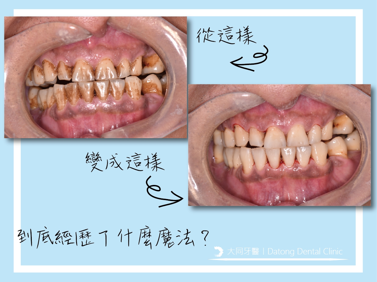 Read more about the article 牙齒黃黃帶垢怎麼辦？丨噴砂美白篇！