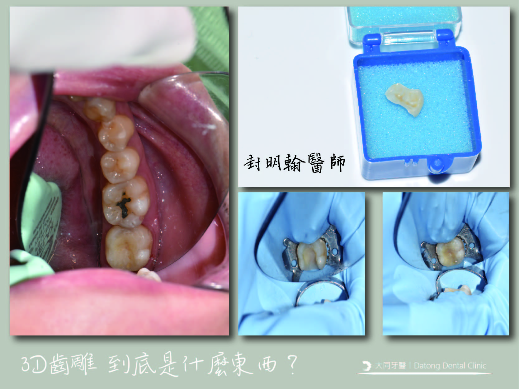 Read more about the article 蛀牙到底為什麼需要自費處理呢？丨齒雕篇！