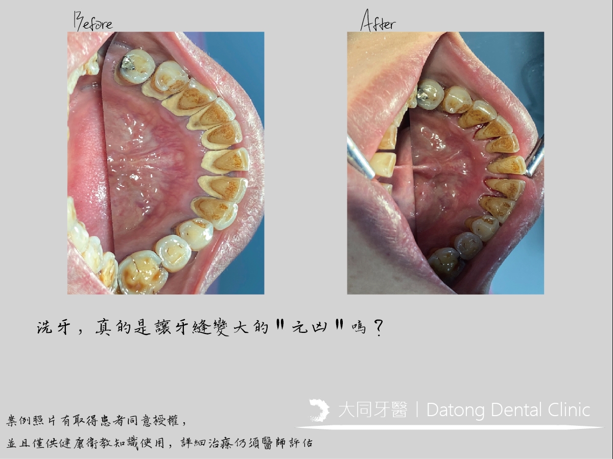 Read more about the article 牙縫變大……真的是因為洗牙嗎？丨定期檢查篇！