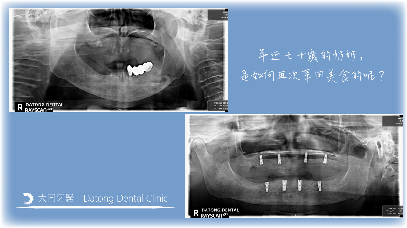 Read more about the article 半固定式活動假牙？丨盧醫師篇