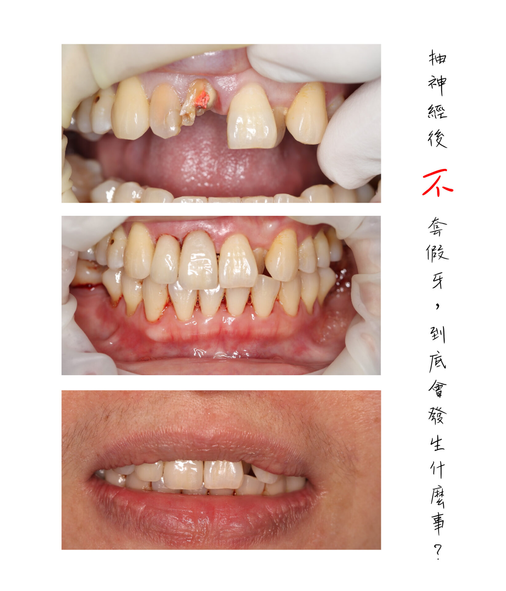 Read more about the article 抽神經後不做假牙，最糟的情況竟是植牙？！丨封明翰醫師篇
