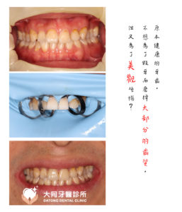 封 貼片 工作區域 1