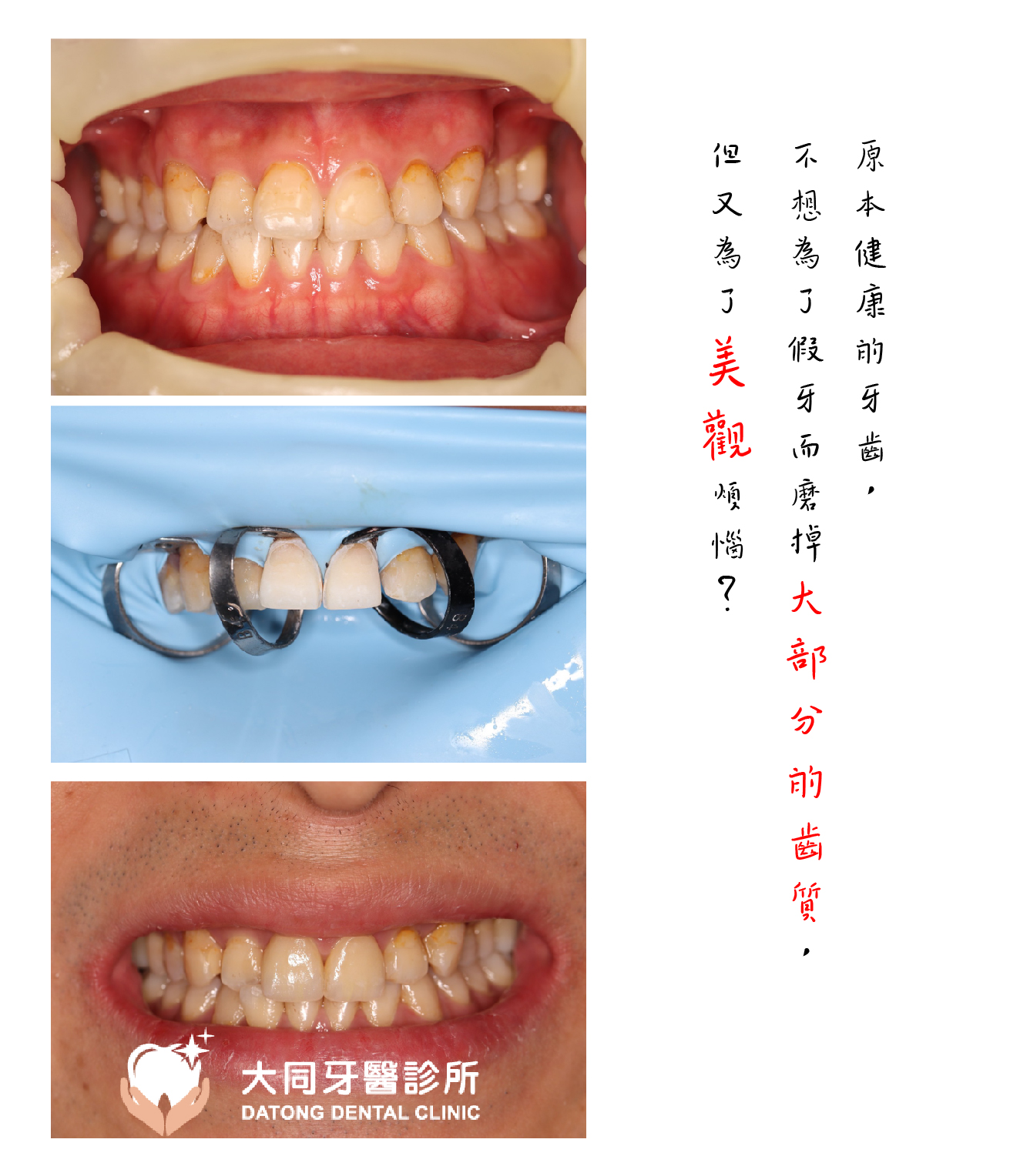 Read more about the article 門牙不美觀怎麼辦？丨美白貼片篇！