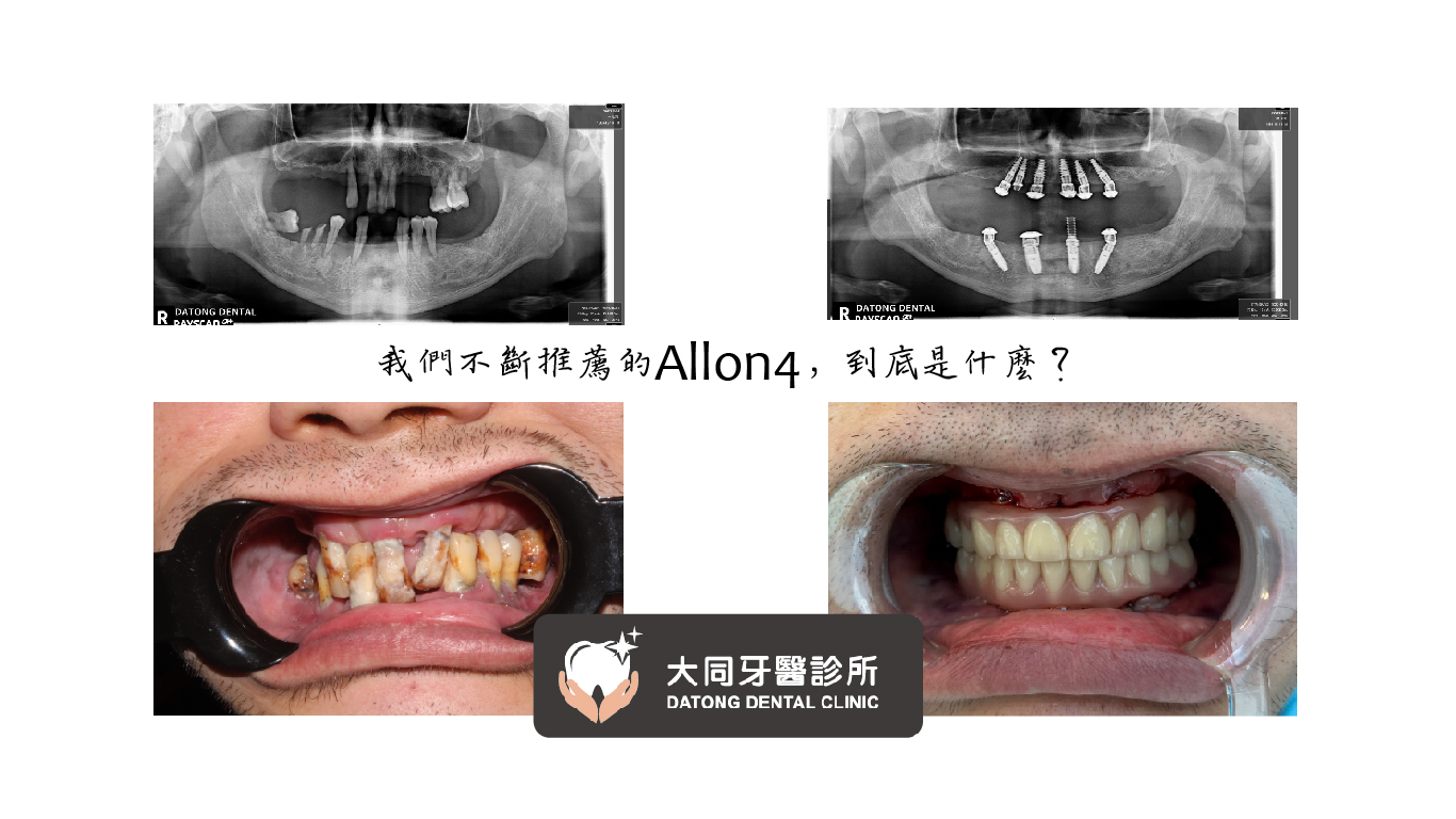 Read more about the article Allon4能不能幫助牙周病?